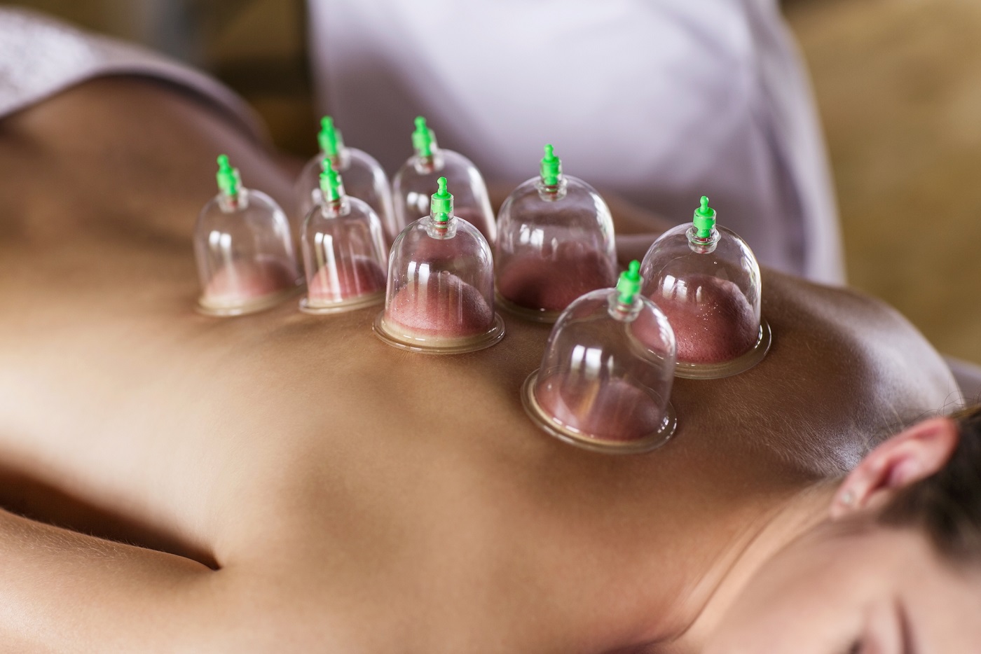 Woman laying on chest with cupping treatment on back